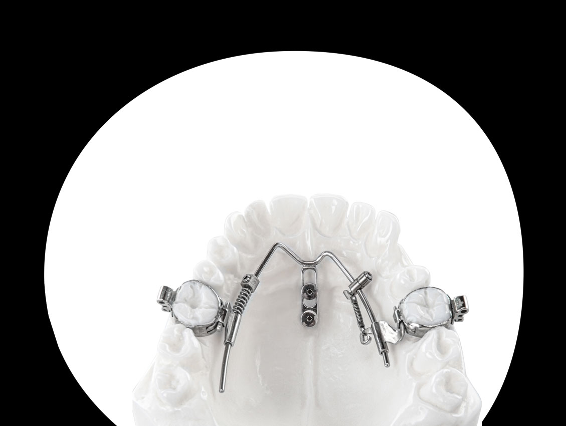 Kieferorthopädie Deggendorf – Modell eines Oberkiefers mit festsitzender kieferorthopädischer Spezialapparatur bei ARTPRAXIS® Deggendorf – individuelle Lösungen für komplexe Zahn- und Kieferstellungen.