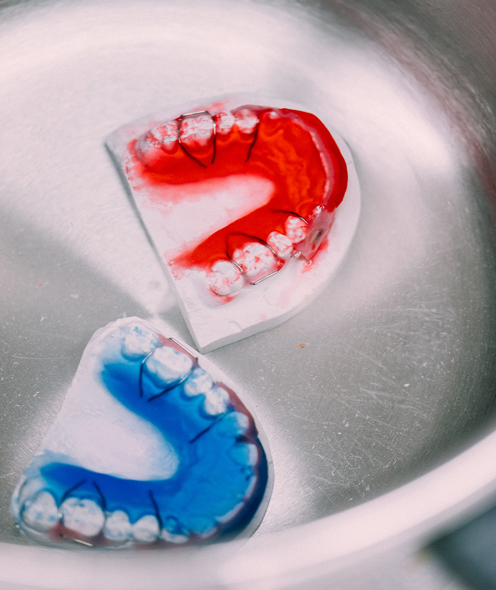 Kieferorthopädie Deggendorf – Zwei bunte Zahnabformungen mit herausnehmbaren Zahnspangen in Rot und Blau, platziert auf einem Metalltablett – Detailaufnahme aus dem kieferorthopädischen Alltag.